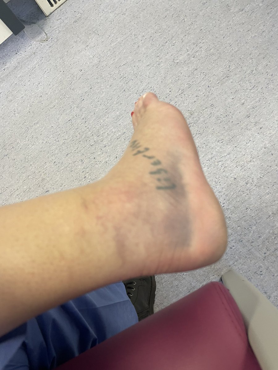 kreeptrina's tweet photo. @chantasia22 @MarioNawfal Looks very similar to how my ankle swelled up after I broke it https://t.co/mfDB0gYrWQ