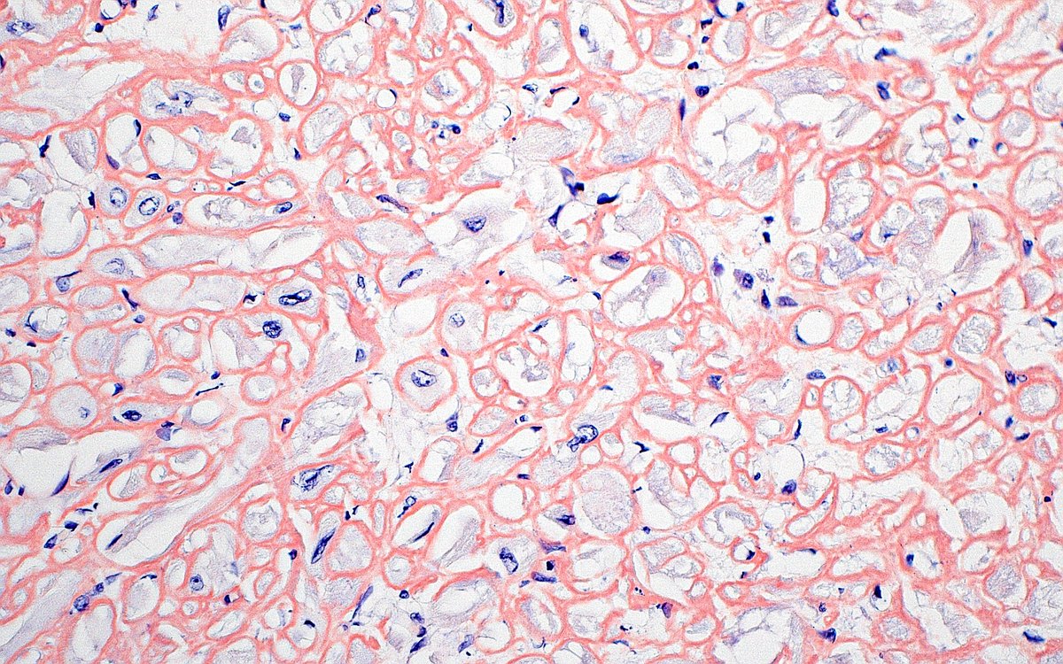 Cardiac Amyloidosis (Congo Red stain) ~ #Pathology #CardiacPath
