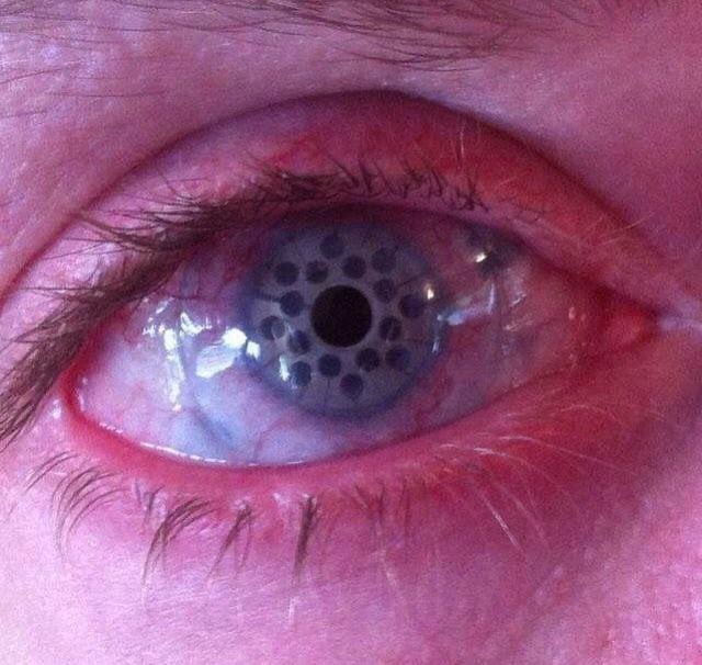 This is the eye after keratoprosthesis, a surgical procedure where a diseased cornea is replaced with an artificial cornea.