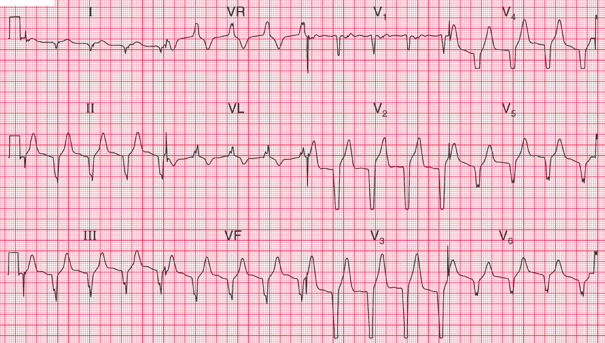 This ECG was recorded from a 45 y/o man, who had been admitted to a coronary care unit with a myocardial infarction and who was recovering well.
- What is the rhythm, and what would you do?

➡️ Answer and Interpretation: manualofmedicine.com/ecgs/ecg-case-…

#medtwitter #foamed #cardioed