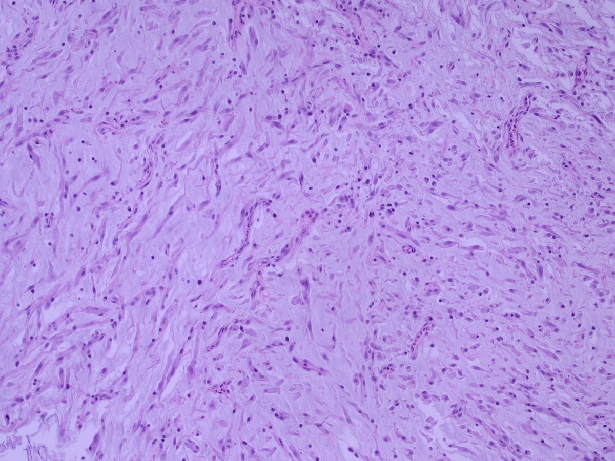 Teclis82's tweet photo. #GUpath #BSTpath #Pathresidents #Surgpath 

Two cases, polls, and some discussion slides.  Enjoy!

Case 1:  A 30 year old female presents with hematuria and a 3cm bladder mass: https://t.co/CsDkSXYcF7