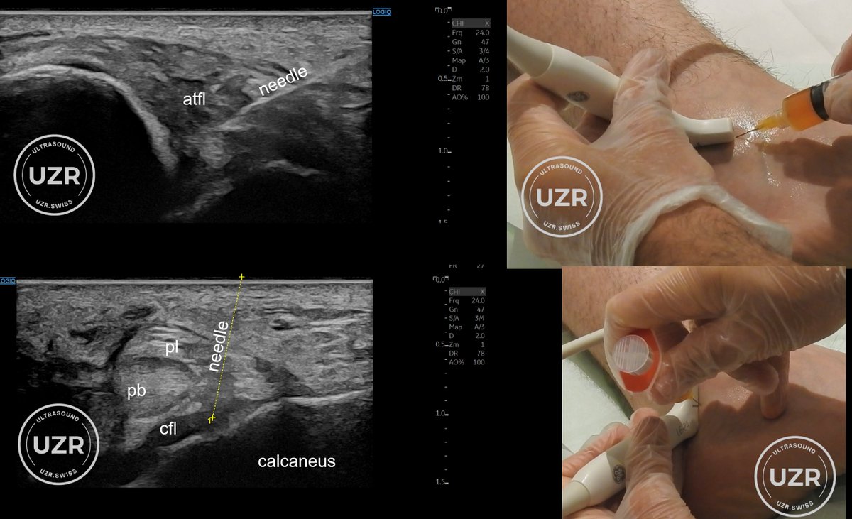 Platelet-Rich Plasma on Ankle Sprains – Efficacy on Pain Reduction and Shorter Return to Play: A Systematic Review of Available Randomized Control Trials jmust.org/elib/journal/d… Watch the full movie here; vimeo.com/uzr/vod_pages