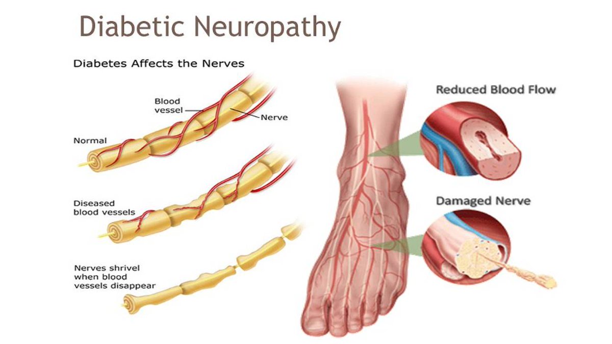📍Diabetic Neuropathic Pain Syndromes

💊 VENLAFAXINE and DULOXETINE are efficacious and are considered first-line drugs for the treatment for diabetic peripheral neuropathy and related neuropathic pain.

#MedEd #MedX #MedTwitter #diabetes #neuropathy #ClinicalPearl