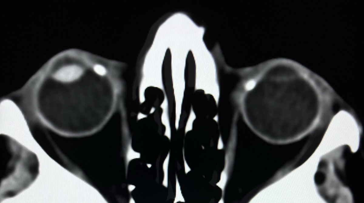 Senile calcific scleral plaques @DrYevSam_Rad @drdevrad @Radiology_Vibes #drvenkimdrd