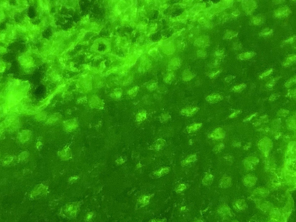 👉🏾Nuclear positivity  (IgG)  in direct Inmunofluorescence ( DIF ) in a skin biopsy

 🚦In vivo antinuclear antibodies

 👆🏻Unusual finding 

✍️Patient  should be investigated for systemic connective tissue

#dermpath #pathology #dermatology 
#dermtwitter