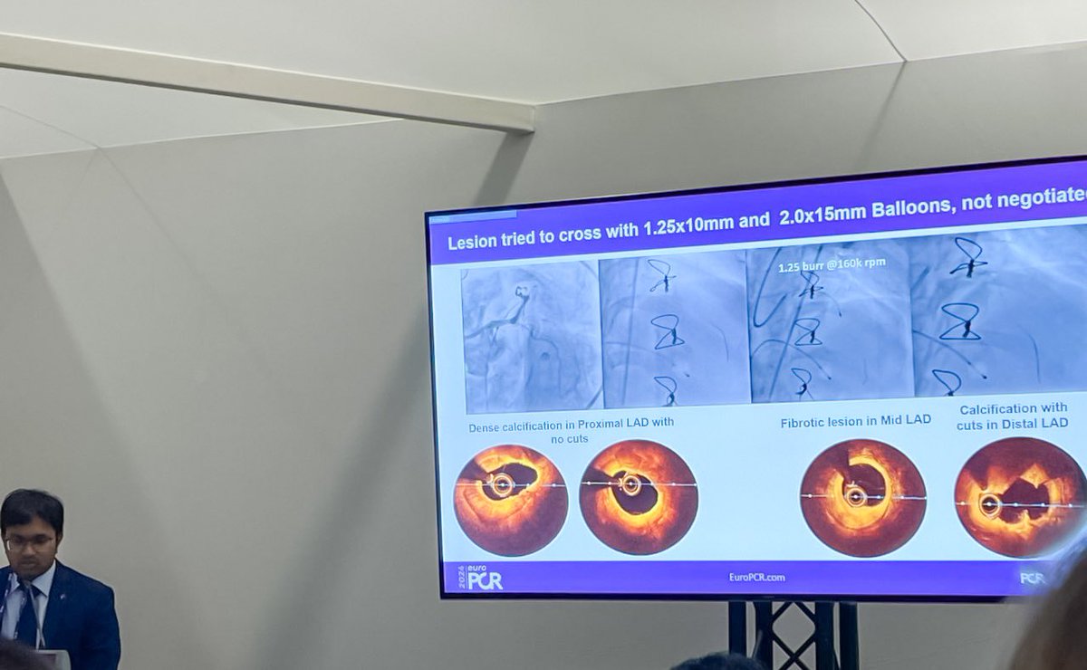 Presented 2 cases in #Europcr2024 #rotatripsy and #leftmain imaging