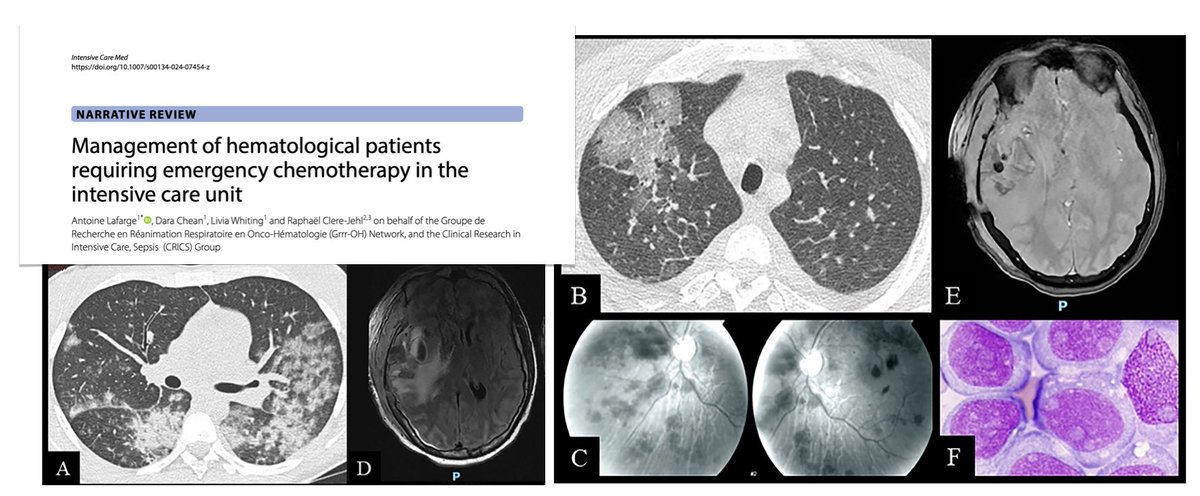 Hematological complications requiring emergency chemotherapy & #ICU 🩸hyperleukocytosis & leukostasis in AL 🩸TLS 🩸DIC 🩸tumor-induced microangiopathic hemolytic anemia 🩸hemophagocytic lymphohistiocytosis 🩸plasma hyperviscosity 🩸myeloma complications 🔓rdcu.be/dImnk