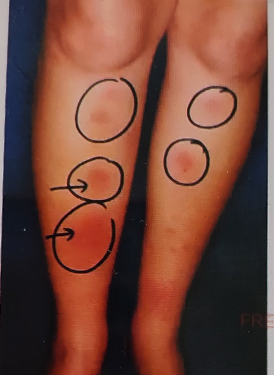 Doctors_GUILD's tweet photo. Name the clinical condition in which erythema Nodosum found?
#NEETUG #NEET #USMLE #MedX #medicine #MEDebate #Education https://t.co/VxaoG9SjI9