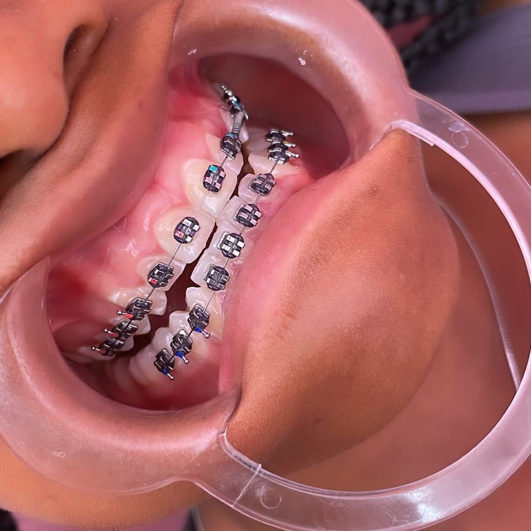 SerembaPatrick's tweet image. New Week New Smiles 😊 
Make yourself an appointment with us 🤗 
#Braces #TeethAlignment 
#Kampala #Uganda 
#Dentist #AskTheDentalSurgeon