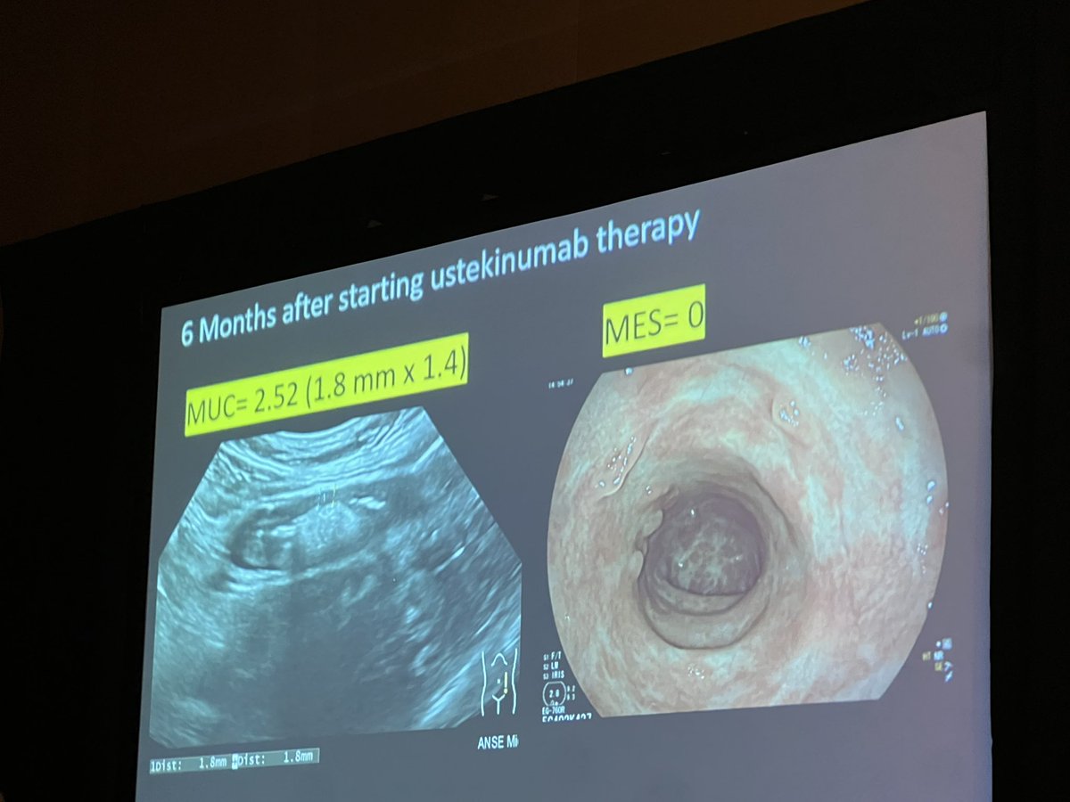 The first #Intestinalultrasound Module 3 course to be offered at #DDW2024 thanks to @HelmsleyTrust! The field of IBD is advancing beautifully in particularly as we integrate @BowelUltrasound globally. 
 @DrMikeDolinger @MariangelaAllo3 @novakkerri @DrSagami @iUSCAN