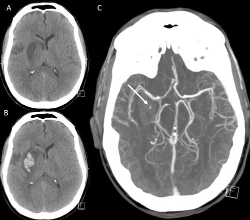 Spot Sign in Hemorrhagic Transformation of Ischemic Stroke onlinelibrary.wiley.com/doi/10.1002/an…