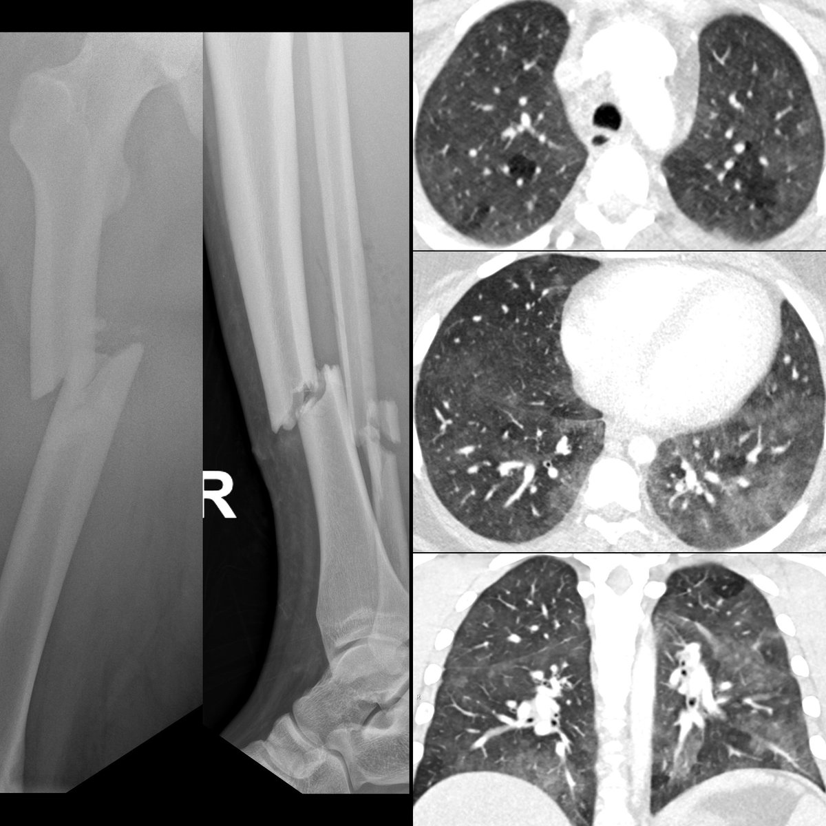 Teen with shortness of breath after motor vehicle accident

AP radiograph of right femur(left)+lateral radiograph of right tibia+fibula(middle) show comminuted fractures of femur, tibia+fibula.

#FOAMed #MedEd #FOAMPed #FOAMRad #PedsRad #RadEd #RadRes #radiology #FOAMcc #PedsICU