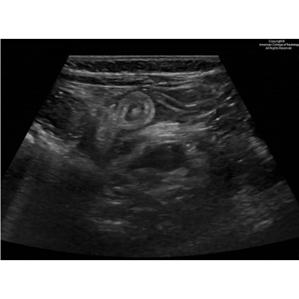 A 2-year-old girl presents to the emergency department with a 1-day history of abdominal pain and a 1-week history of appetite loss after recently emigrating from Honduras. #ACRCaseinPoint bit.ly/49Ou3lj