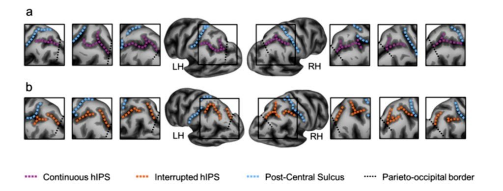 🌟 Thrilled to share our @CommsBio article on how the right intraparietal sulcus (IPS) morphology impacts memory and language. 🧠✨ This highlights brain morphology as a neural fingerprint. 🧩🔍 #Neuroscience #BrainResearch #Cognition 

Freely available 
rdcu.be/dGAoL
