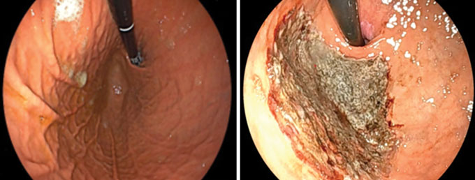 ScienceNews's tweet photo. Doctors threaded an endoscope (black tube) down a patient’s throat and into their stomach (left). Then, they burned away a patch of tissue lining the upper part of the organ (gray section, right). That destroyed cells that produce a key hunger hormone.

https://t.co/QjonH2m0yM https://t.co/Hr0C2LMvpE