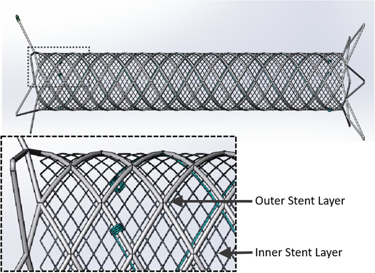 #tb to 2022 ↩️ Real-World Study of a Dual-Layer Micromesh #Stent in Elective Treatment of Symptomatic and Asymptomatic #CarotidArtery Stenosis (ROADSAVER) link.springer.com/article/10.100… #OpenAccess 🔓