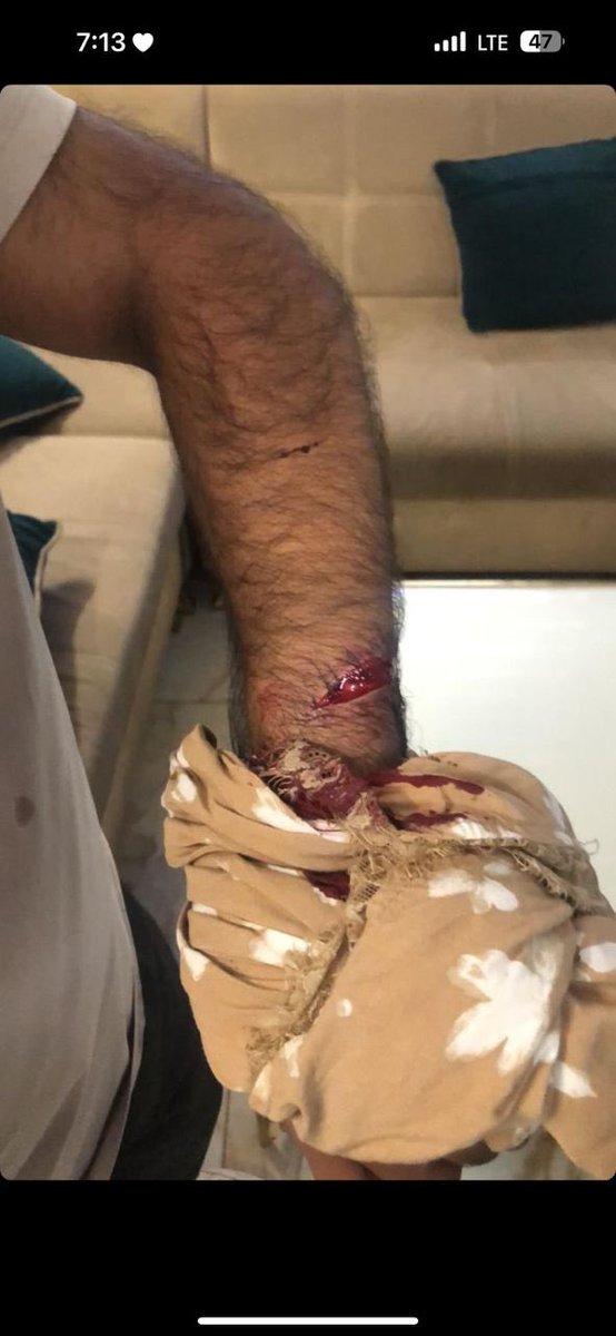 cm_farooqanwar's tweet photo. The riot are going to start again 
This time they got sharp instruments and they cut one student forearm 

#savestudentsinkyrgyz https://t.co/M9tSJBVdc2
