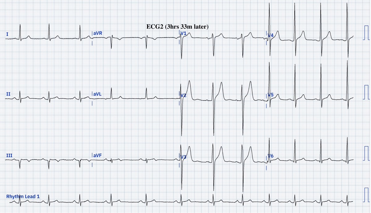 CP Dx? @yolyabreuh @UlhasDr @DidlakeDW @ecgrhythms @syamkumarmd @IhabFathiSulima @DocNikko @DrPharmDMDTh @Vadeboncoeur_Al @smithECGBlog @EM_RESUS @iamritu @paomorejon @martinfd78 @estudiomedicina @OrlandoRPN @fxgodzeuss #EPeeps #Cardioed #FOAMcc @akneton @ecgandrhythmRoe