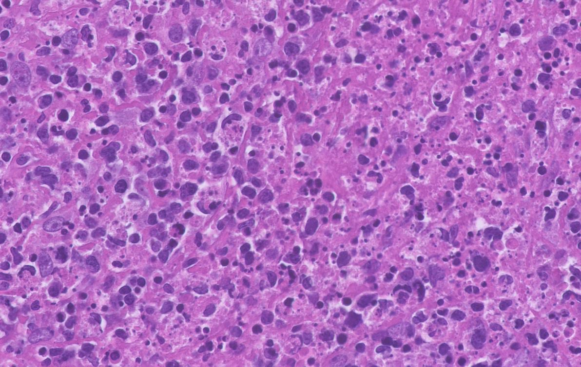 Tiger_heme's tweet image. Axillary LN, 29 yo woman. What are the arrows pointing at?