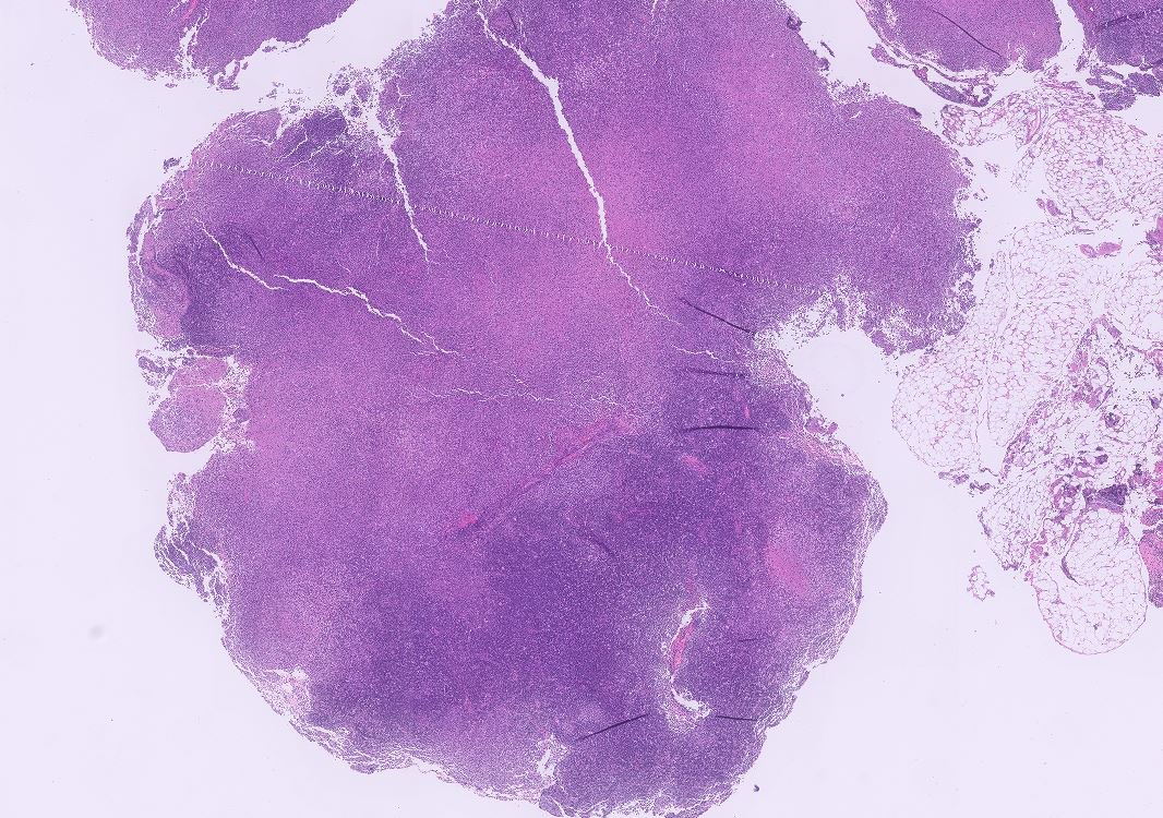 Tiger_heme's tweet image. Axillary LN, 29 yo woman. What are the arrows pointing at?