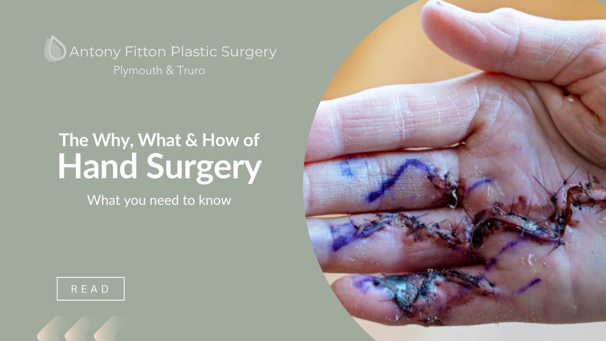 AntonyFitton's tweet image. Do you require #HandSurgery to alleviate pain, injuries, abnormalities or trauma? 
We can help. 

Hand surgery can be highly beneficial in improving hand function, relieving pain, and restoring quality of life.
buff.ly/3wvvGXi 

#HandFunction #HandInjuries #HandPain