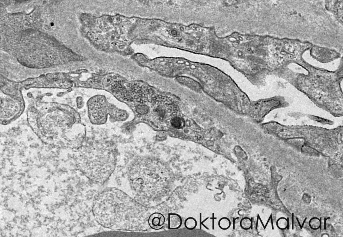 Grace L. Malvar, MD (@doktoramalvar) on Twitter photo 1st image 2500X EM feat. en face view of fenestrated endothelium, effaced podocytes, and multiple tubulo-reticular inclusions. What are possible conditions that can have these findings if the biopsy is from:
1) native kidney?
2) allograft kidney? 
#RenalPath 1st image 2500X EM feat. en face view of fenestrated endothelium, effaced podocytes, and multiple tubulo-reticular inclusions. What are possible conditions that can have these findings if the biopsy is from:
1) native kidney?
2) allograft kidney? 
#RenalPath