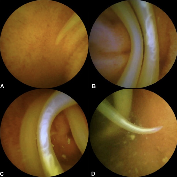 Capsule endoscopy findings in a 52F with a 2 year history of recurrent abdominal distension and pain. OGD and colonoscopy had been normal. What’s the diagnosis?