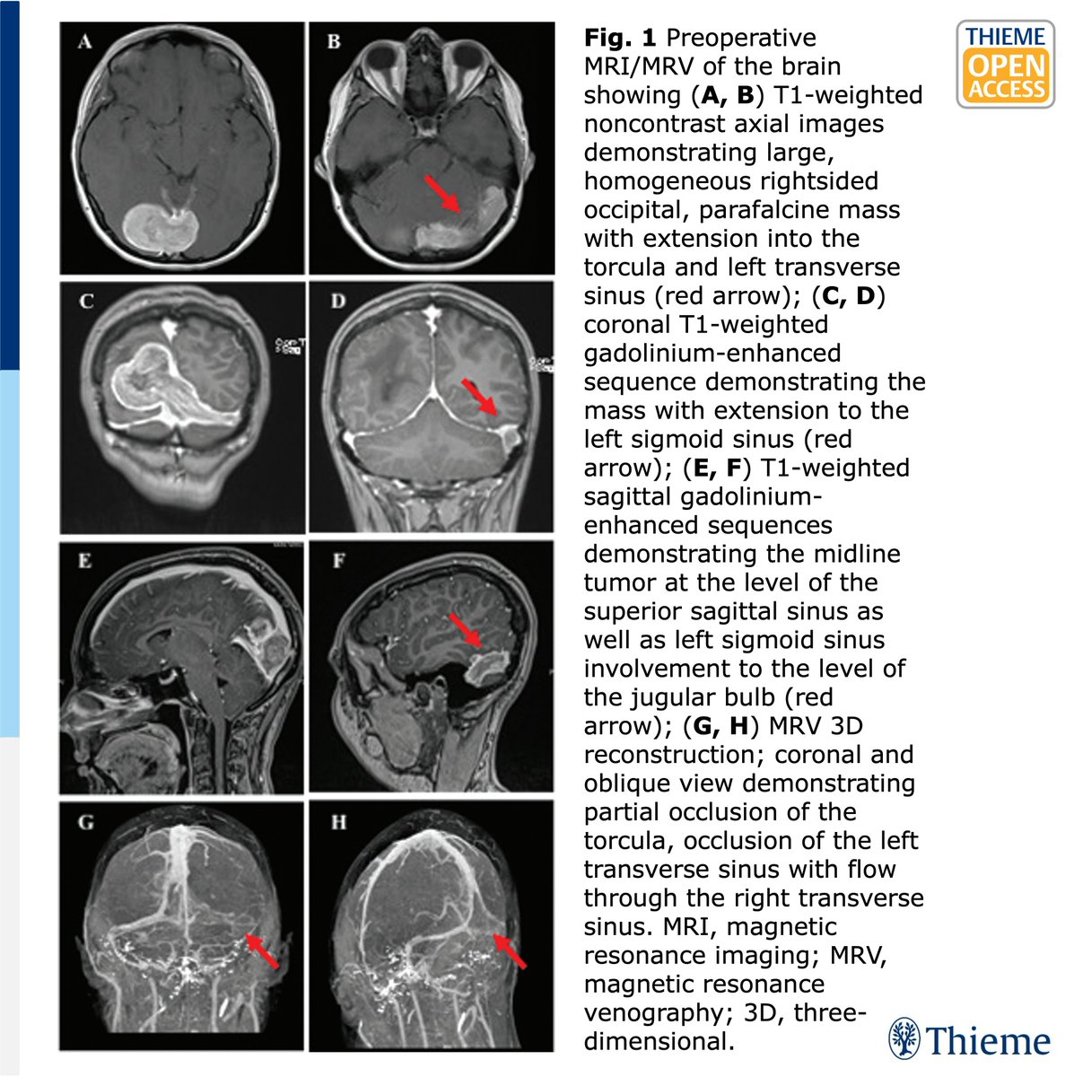 📢#OpenAccessSunday
🧠How do you manage torcular #meningioma?

Meningiomas involving the confluence are challenging & require careful risk-benefit considerations. Read this staged surgical & #radonc management in a 21-yo pt & #literaturereview:
thieme-connect.com/products/ejour…

#JNLSR