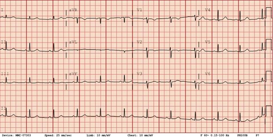 🔴 ECG Abnormalities of Caffeine Overdose | Circulation: Arrhythmia and Electrophysiology

ahajournals.org/doi/full/10.11…
#cardiotwiteros #meded #medtwitter #CardioTwitter #emergency #cardiology #CardioEd #criticalcare