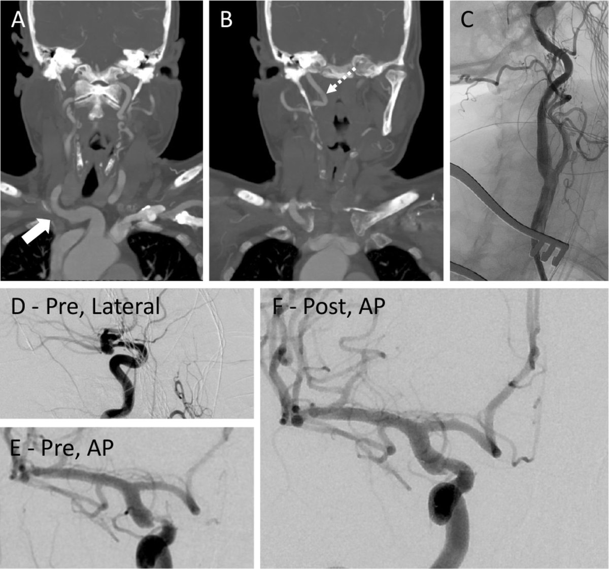 Study: TCAR was successfully used in 20 patients for #endovascular treatment of various neurovascular conditions like ICAD and aneurysm #flowdiversion bit.ly/4bnPNFY @MatoukCharles @SujijantaratMD @jpantonios @AndrewBKoo @AbdelazizAmllay @sheth_kevin @DadaRenedo