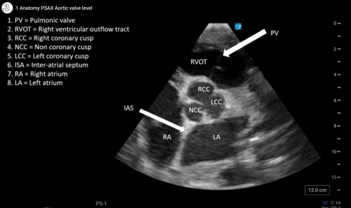 Pulmonary-POCUS (@hoosierpocus) on Twitter photo 1/2 :Congratulations to this week's winner. All hail the chief <a href="/dpfeifleMD/">Dan Pfeifle, MD</a> , rising chief Fellow for PCCM! Dan enjoy a cup of coffee on us! ☕
Here's a quick recap of last week's metrics:
We received a total of 79 responses.
For question #1, 94% of participants answered 1/2 :Congratulations to this week's winner. All hail the chief <a href="/dpfeifleMD/">Dan Pfeifle, MD</a> , rising chief Fellow for PCCM! Dan enjoy a cup of coffee on us! ☕
Here's a quick recap of last week's metrics:
We received a total of 79 responses.
For question #1, 94% of participants answered