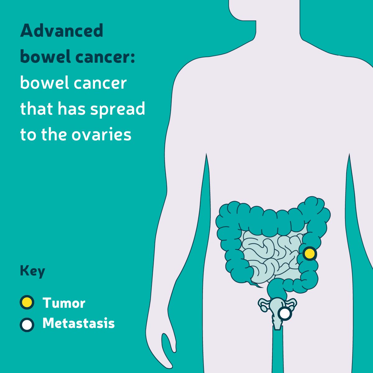 When #BowelCancer spreads to the ovaries it's called ovarian metastasis. A team of experts will help decide the best treatment for you. Our information is here to support you💛 Find out more about when the disease spreads to other parts of the body: bit.ly/4b61cKI