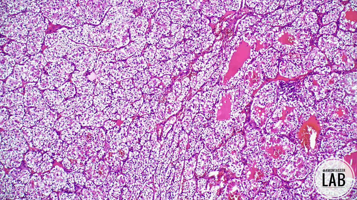 🔬 CCRCC : « complex vascular network with capillaries surrounding essentially every nest of tumour cells » WHO blue book 5th edition #GUpath #Pathology #PathTwitter #PathX