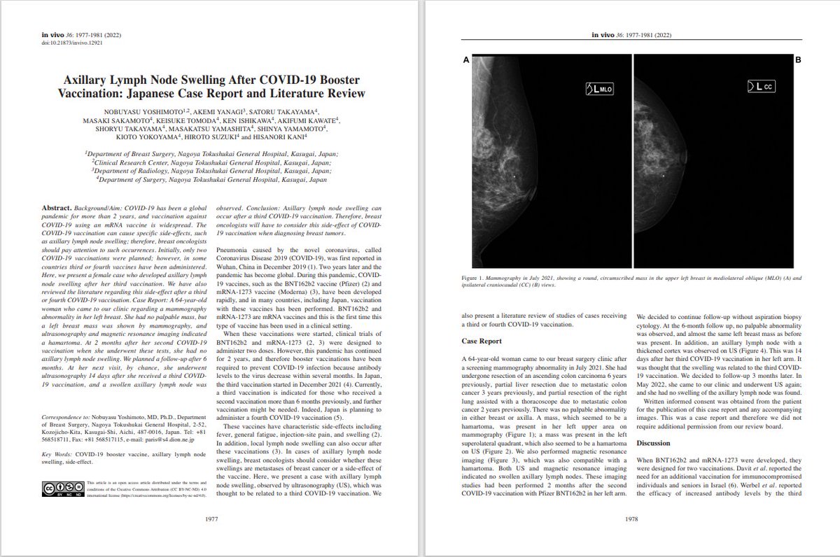 breast oncologists should continue to be aware of axillary lymph node swelling related to COVID-19 vaccinations when diagnosing a breast tumor. Further research on the side-effects of C-19 vaccinations, especially axillary lymph node swelling, is required. iv.iiarjournals.org/content/invivo…