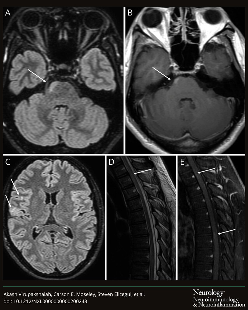 This case highlights an unusual presentation of severe MOGAD, emphasizes the potential benefit of plasma exchanges in severe #MOGAD cases refractory to steroid treatment, and demonstrates how assessment of CSF IL-6 may help guide treatment decisions: bit.ly/3w5SUD5