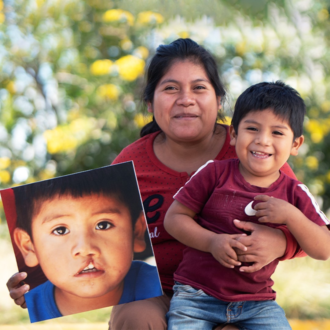 Meet Israel from Mexico! Thanks to your donations, Smile Train enabled Israel to access cleft surgery and crucial care, including preventative dental care and nutritional support. #CleftLipAndPalateAwarenessWeek