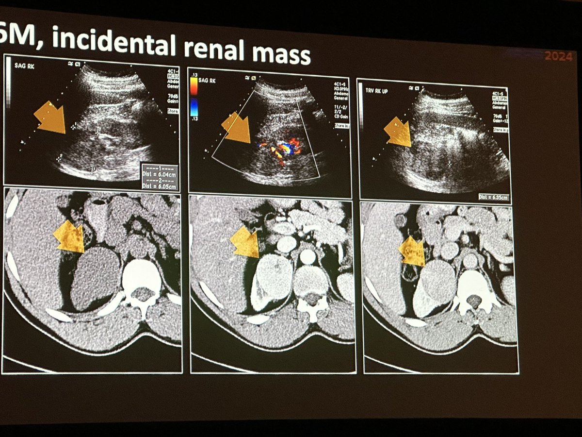 @danatsouza is dropping some serous renal mass knowledge in Ballrom A #ARRS24
