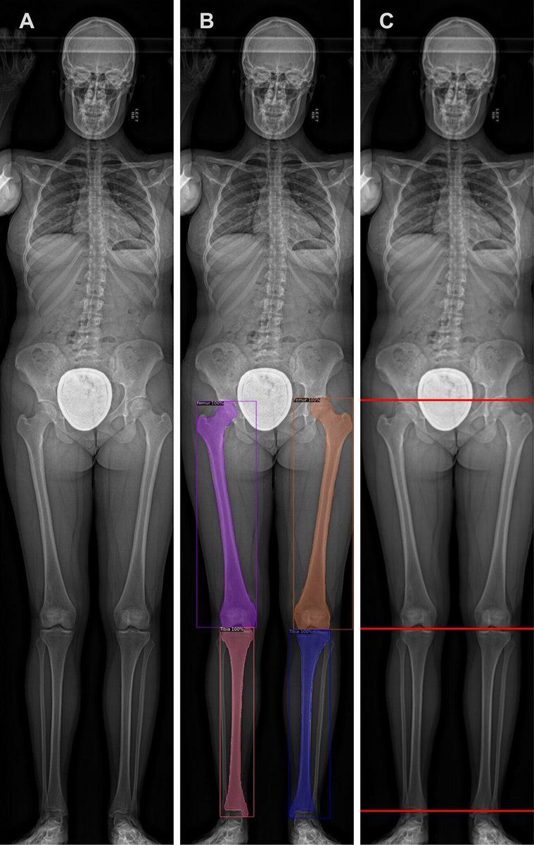 radiology_rsna's tweet photo. Lower extremity growth curves derived from AI measurements of the tibia and femur on standing slot-scanning radiographs in pediatric patients were more accurate than those from the standard Anderson-Green method. @columbiaimaging @johnrzech @djaramillomd https://t.co/ePSVF3VAl9 https://t.co/3jDRtrK8gb