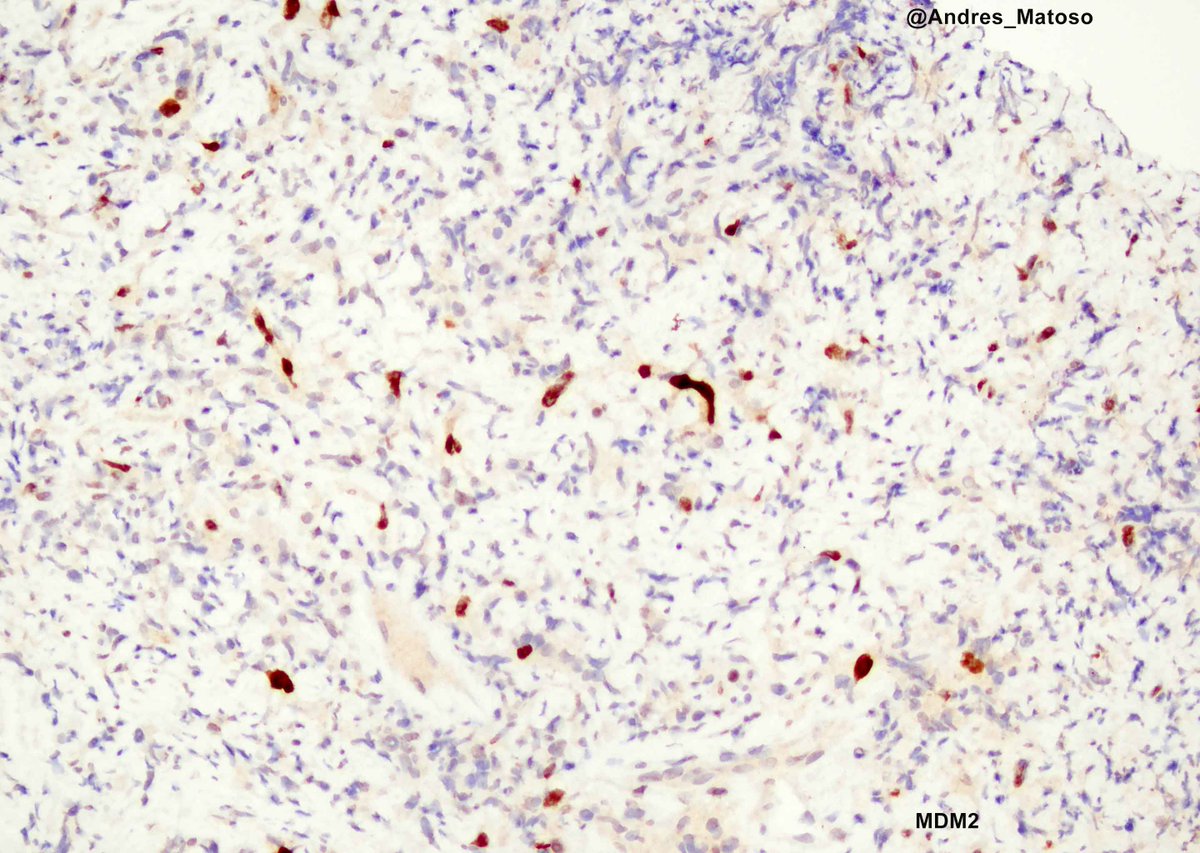 Paratesticular mass simulating a lymphoid/inflammatory disorder. Very difficult to diagnose if we don't consider liposarcoma in the differential. See publication by P Argani et al. pubmed.ncbi.nlm.nih.gov/9255251/ #gupath @JHUPath