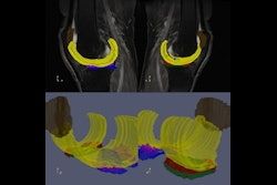 A #MRI radiomics model can predict the need for knee replacement surgery, according to a study presented at #ISMRM2024. buff.ly/4dxsqvs For more from #ISMRM2024, visit our RADCast: buff.ly/3y7T4dU @ISMRM #MR #MagneticResonance #radiology #ImagingAI #radiomics