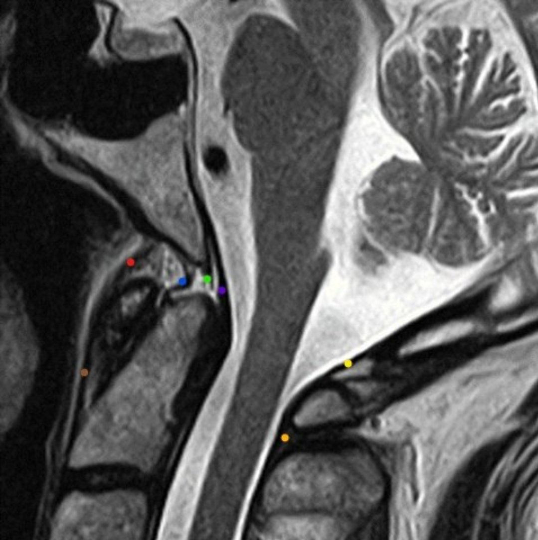 #RadRes:  Can we discuss #craniocervical trauma?

Me:  Absolutely!  Lets start here...

#NeuroRad #Spine