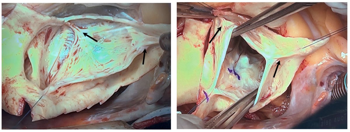 Forme fruste unicuspid aortic valve. Arrows mark the two raphae. One well developed and one rudimentary. May be misinterpreted as a Type A bicuspid aortic valve. But it’s not.