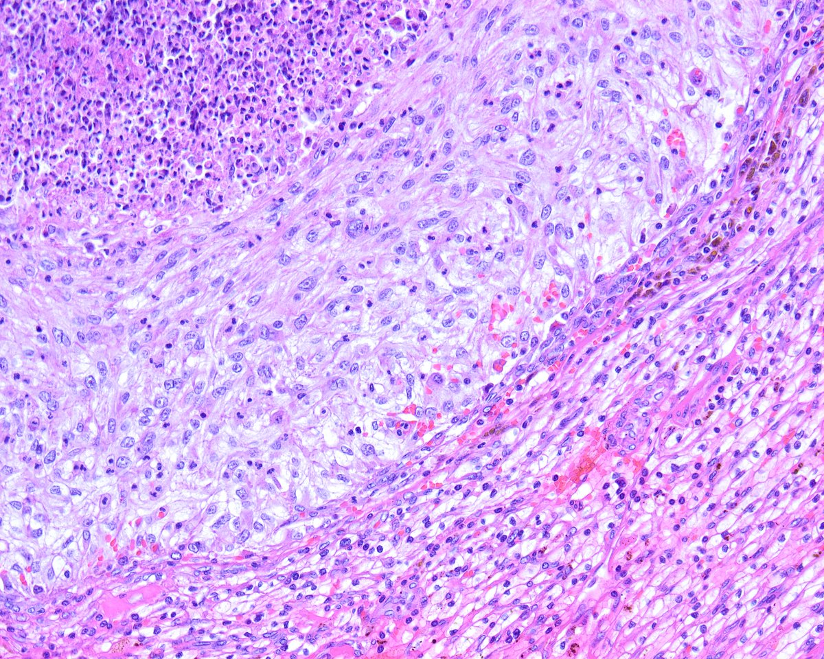 Clear cell renal cell carcinoma (CCRCC) with sarcomatoid areas. 2 patterns are present, one with necrosis (the sarcomatoid/spindle cell component, grade 4). The sarcomatoid component lacks sinusoidal-like vasculature, present in the usual CCRCC (grade 1). innovativesciencepress.com