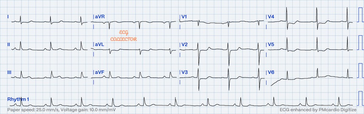 Midnight clinic case consultation; 45 y.o male smoker; feeling bloatedness and central chest discomfort after late dinner; VS stable; What is your thought on the #ECG❓🤔 #CardioTwitter #MedTwitter #Medicalstudent @PMcardioApp