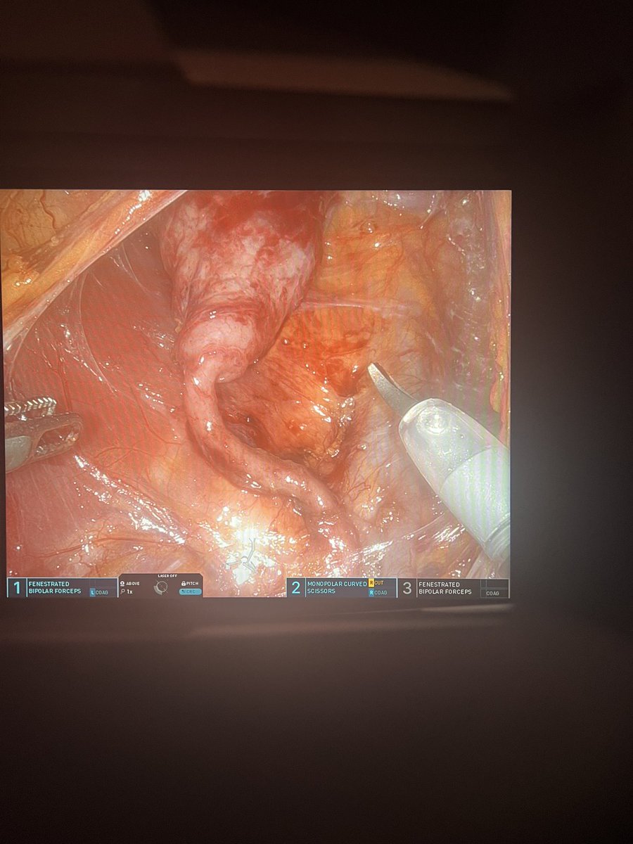 David Jiang (@davidjiangmd) on Twitter photo Lower anterior access single port retroperitoneal pyeloplasty. Supine position with a small bump. Got to this view ~10min after docking. <a href="/IntuitiveSurg/">Intuitive</a> <a href="/rkorets/">Rus Korets MD 🇺🇦</a> <a href="/SimoneCrivella2/">Simone Crivellaro</a> <a href="/RoboticsUrology/">Mutahar Ahmed</a> Lower anterior access single port retroperitoneal pyeloplasty. Supine position with a small bump. Got to this view ~10min after docking. <a href="/IntuitiveSurg/">Intuitive</a> <a href="/rkorets/">Rus Korets MD 🇺🇦</a> <a href="/SimoneCrivella2/">Simone Crivellaro</a> <a href="/RoboticsUrology/">Mutahar Ahmed</a>
