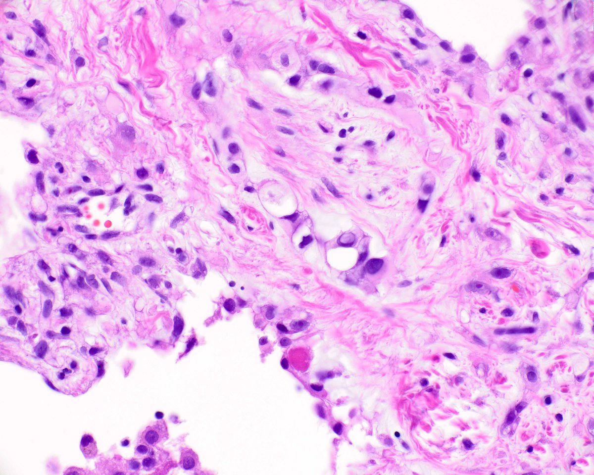 Epithelioid hemangioendothelioma involving the lung. The patient had extensive disease in several organs; the primary site was unclear. In the lung, there is an organ-encasing growth pattern similar to that of mesothelioma. #UMiamiPath