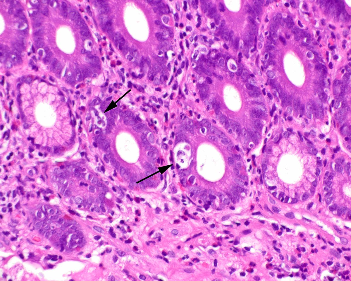 Autoimmune enteropathy pattern of injury. Missing in action: goblet cells, Paneth cells. Present - increased apoptotic bodies. This pattern is attributed to several underlying causes, including use of angiotensin receptor blocker anti-hypertensive medications. PMID: 33607573.