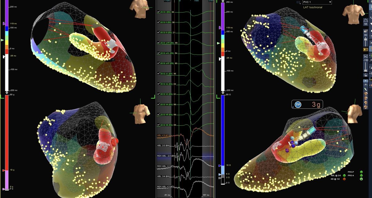 PVC mapped to the apical base of AL Pap, predicted by ECG. #PDXTechnique used to highlight earliest, ablated using #TactiCath 

ahajournals.org/doi/full/10.11…

#PMA