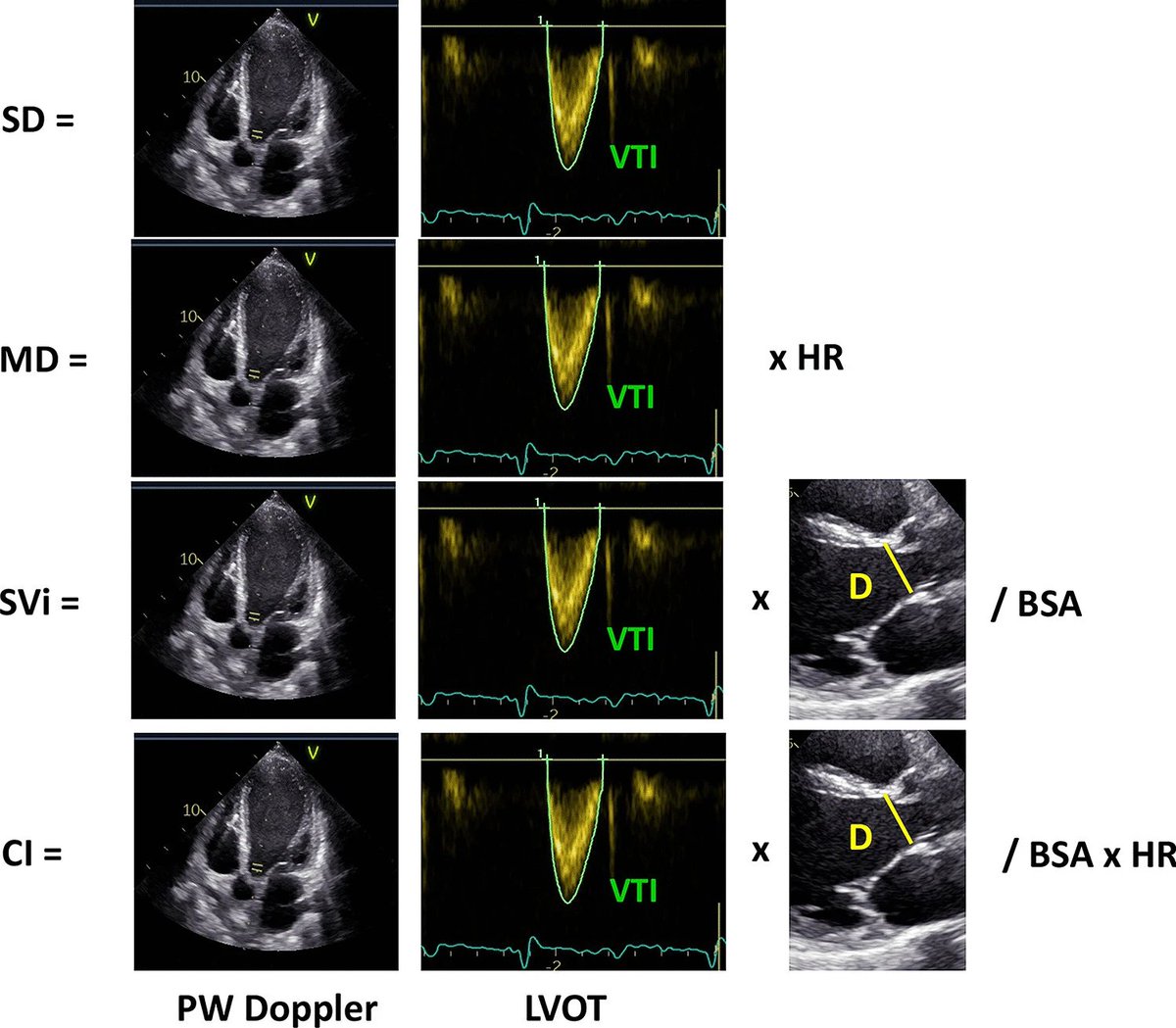 New perspectives in the echocardiographic hemodynamics multiparametric assessment of patients with heart failure.
#POCUS #FOAMed #FOAMcc 
🔗link.springer.com/article/10.100…