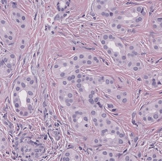 #GIpath #Liverpath #Pathresidents

1cm liver lesion noted during cholecystectomy on a 40 year old man.  Poll in reply.